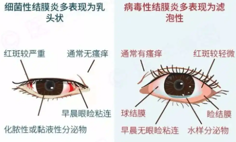 红眼病易传染,千万别让它找上你! - 松桃苗族自治县人民医院【官网】