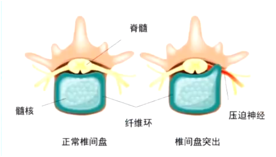 椎间盘突出是导致脊髓损伤的主要病因之一。