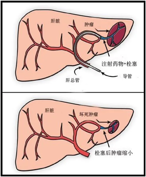 肝癌介入栓塞图片图片